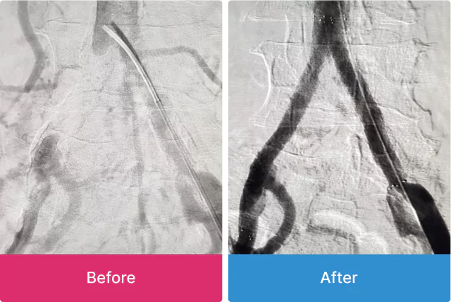 Angioplasty