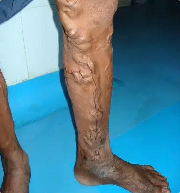 Bulging veins