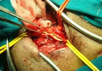 Carotid Endarterectomy