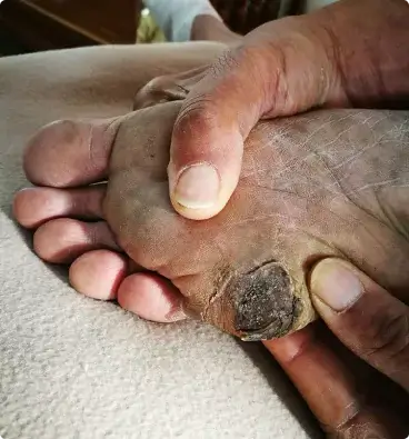 Gangrene/ Diabetic foot problems