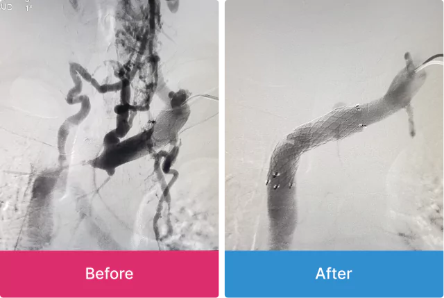 Left Innominate Vein occlusion