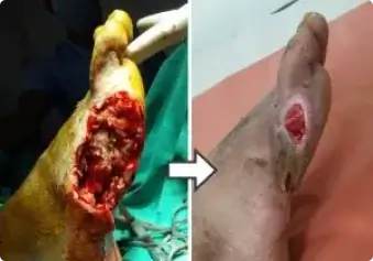 Leg Ulcer Treatment By VAC Therapy / HBOT