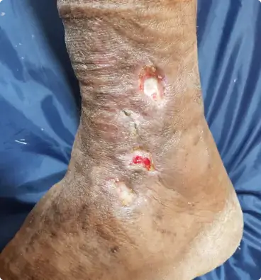 Leg ulcer