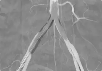 Peripheral Angioplasty