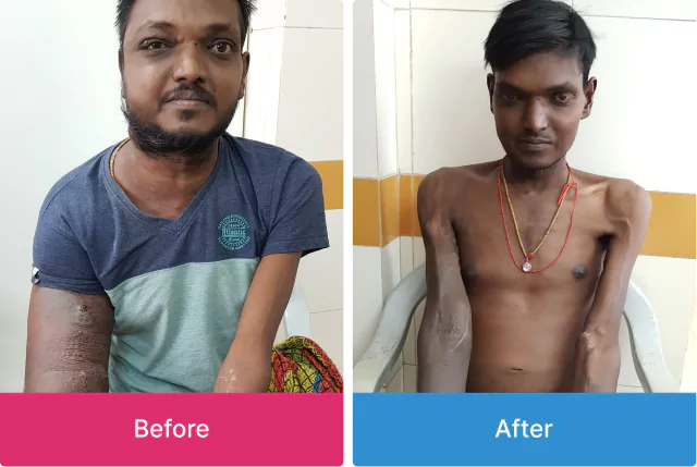 Swelling Reduced