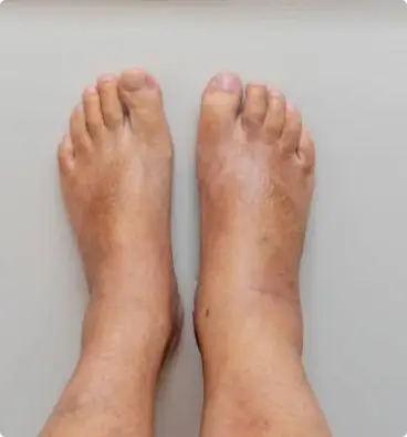 Swollen feet and ankles