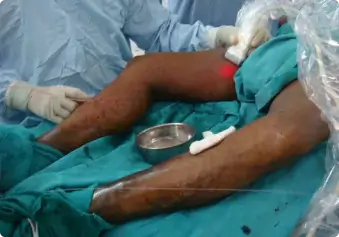 Varicose Veins Treatment