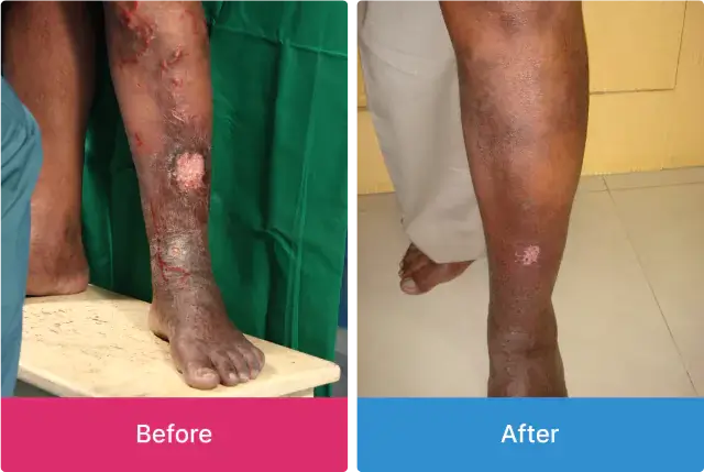 Varicose Veins