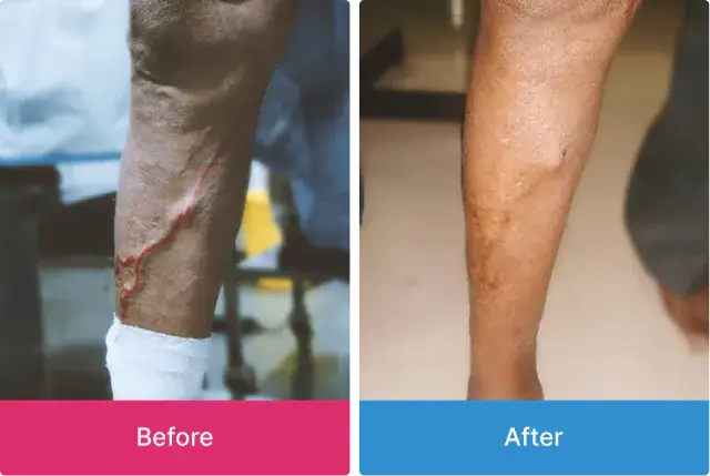Varicose Veins