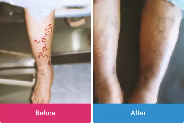 Varicose Veins