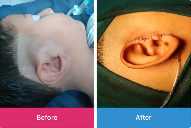 Vascular Malformation