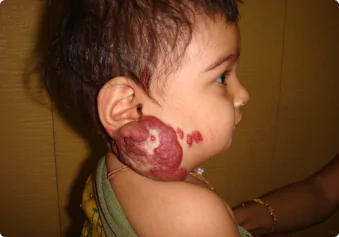 Vascular Malformation